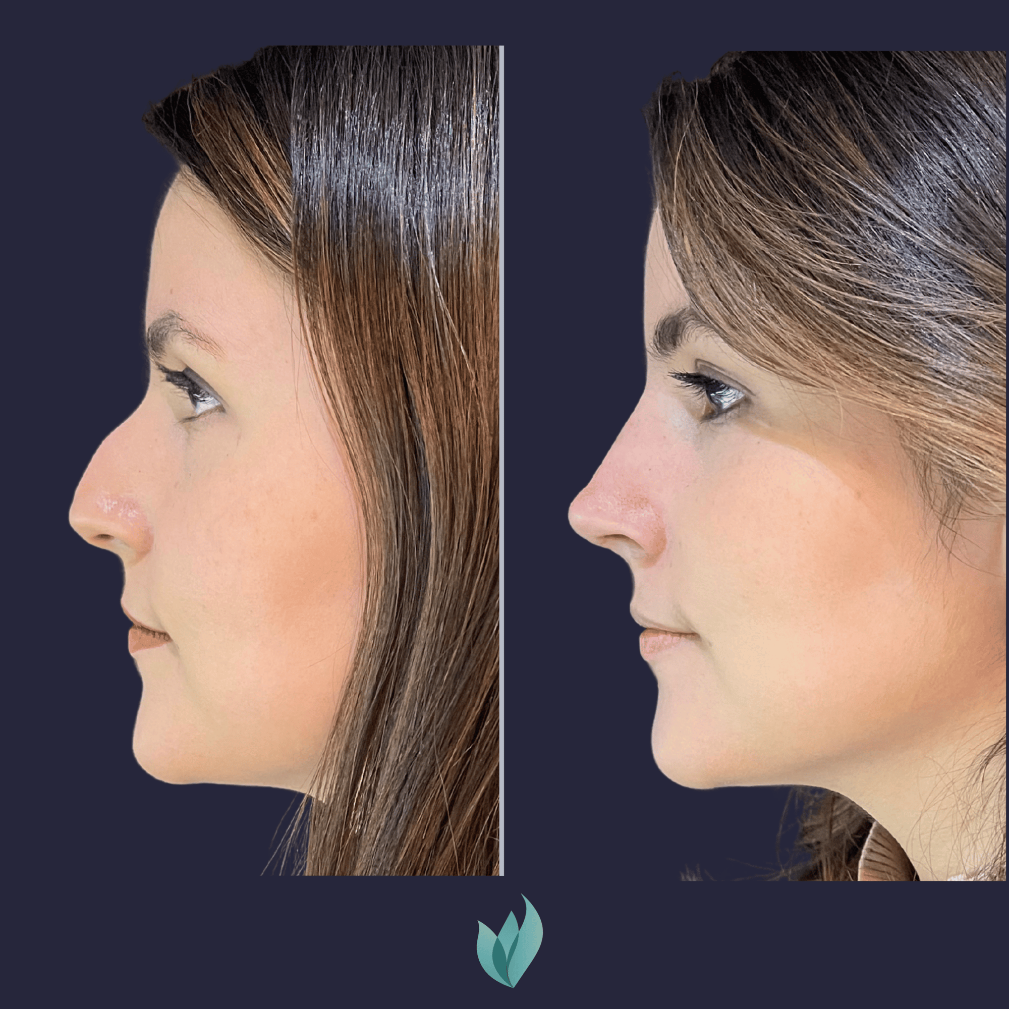 Caso Rinoplastia Dr Federico Vargas