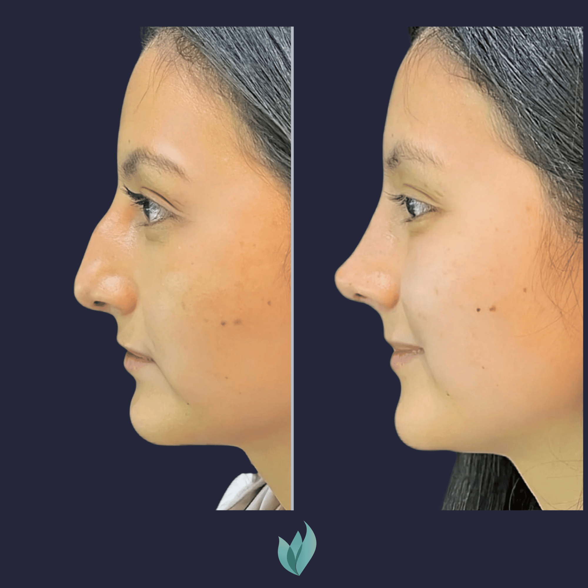 Caso Rinoplastia Dr Federico Vargas