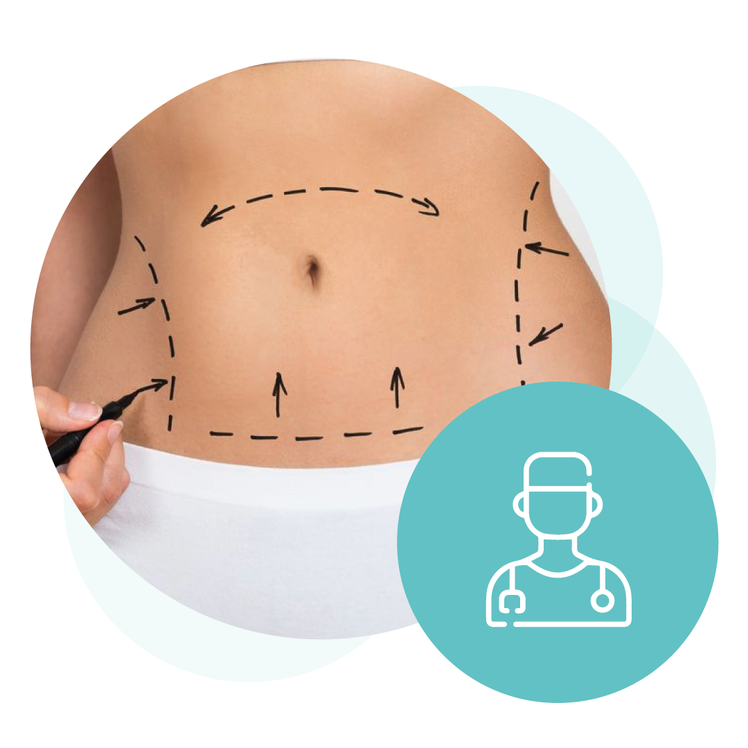 Abdominoplastia-1