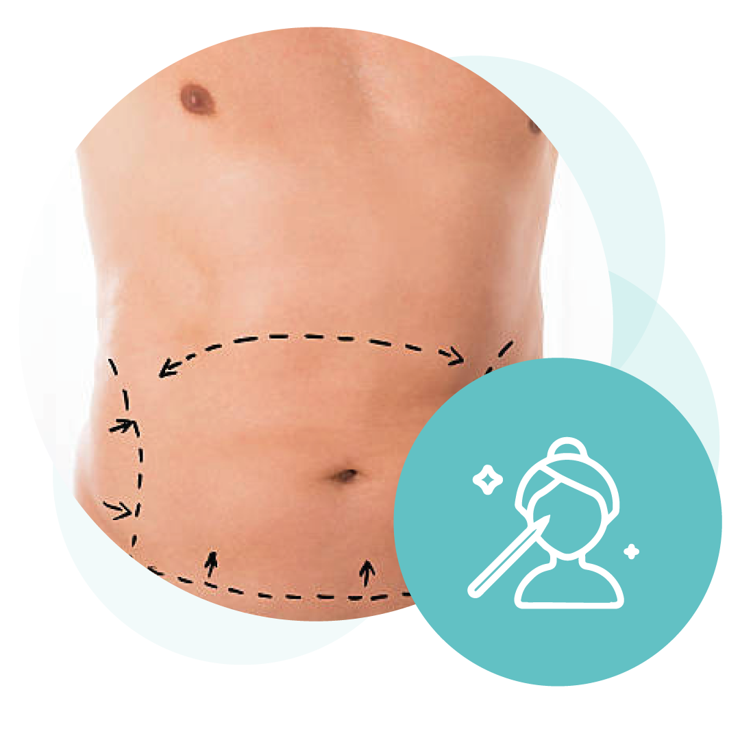 Abdominoplastia-2