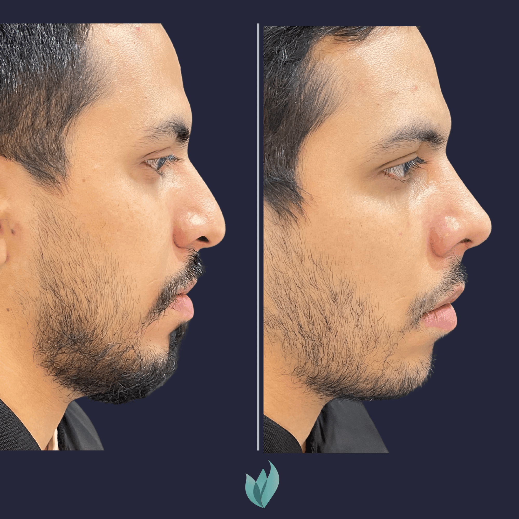Dr Federico Vargas Rinoplastia Bogota (10)