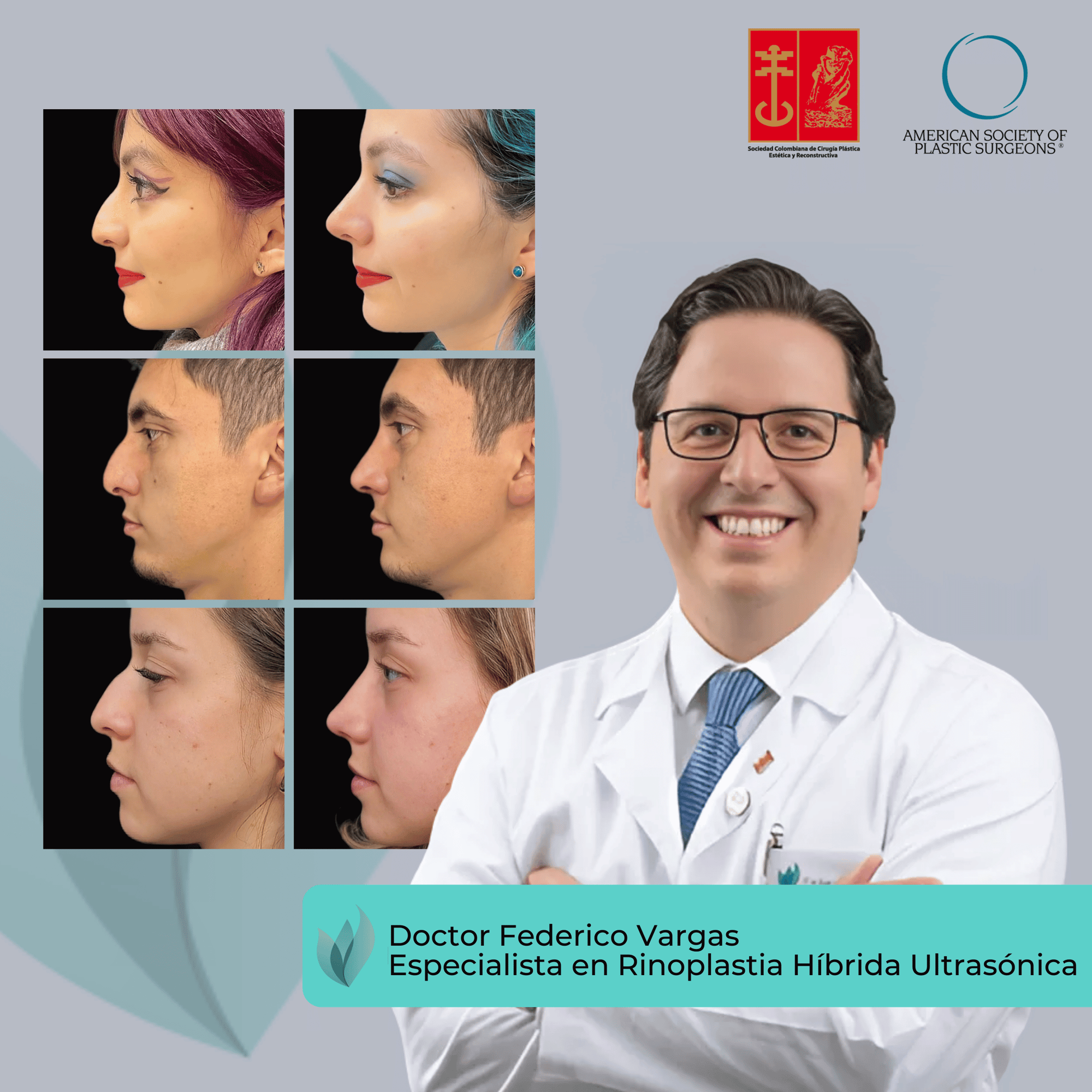 Dr Federico Vargas Rinoplastia Bogota (13)