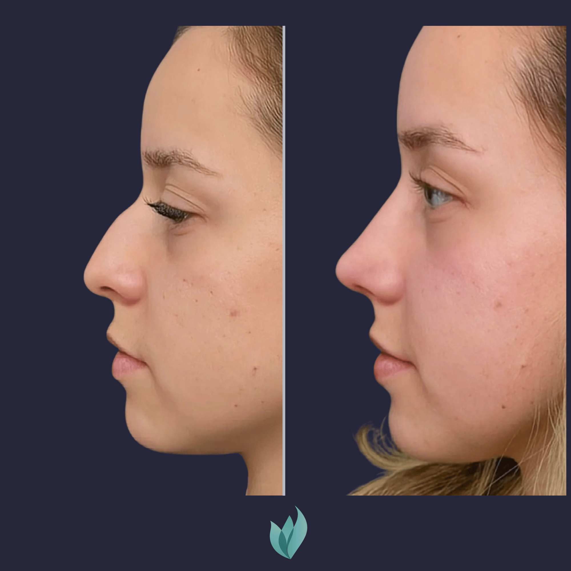 Dr Federico Vargas Rinoplastia Bogota (15)