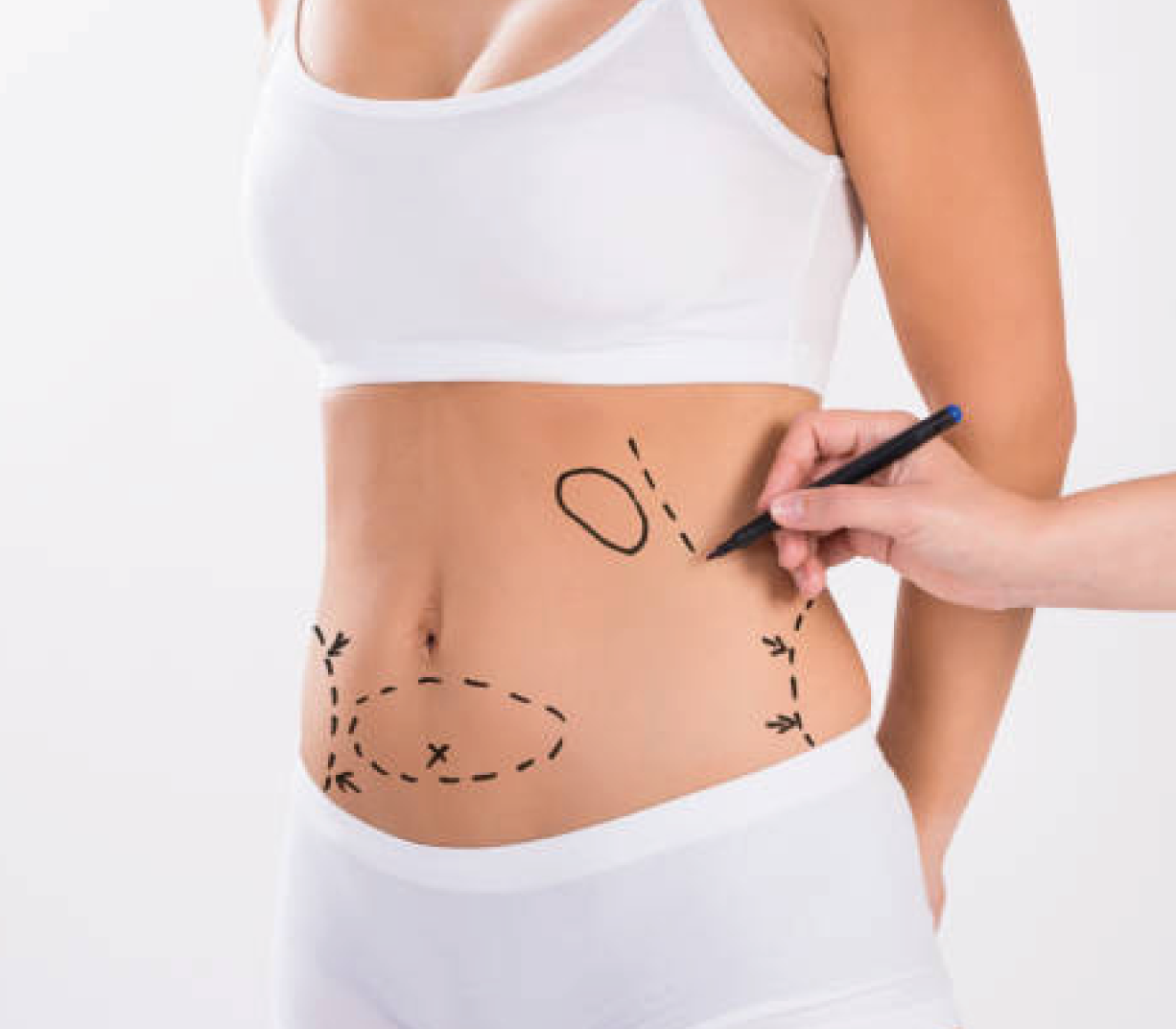 Abdominoplastia